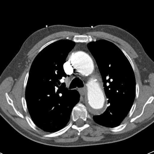 Aortic intramural hematoma (Radiopaedia 31139-31838 B 33).jpg
