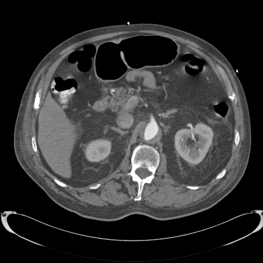 Aortic intramural hematoma (Radiopaedia 34260-35540 B 48).png