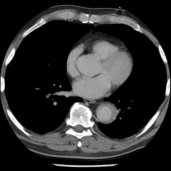 Aortic intramural hematoma (type B) (Radiopaedia 79323-92387 Axial C+ delayed 33).jpg