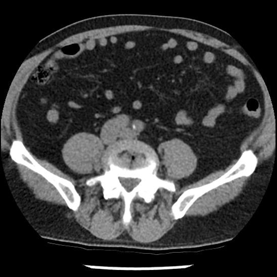 Aortic intramural hematoma (type B) (Radiopaedia 79323-92387 Axial non-contrast 85).jpg