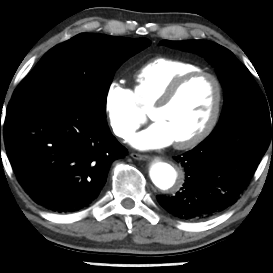 Aortic intramural hematoma (type B) (Radiopaedia 79323-92387 B 37).jpg