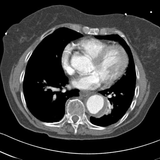 Aortic intramural hematoma from penetrating atherosclerotic ulcer (Radiopaedia 31137-31836 A 51).jpg