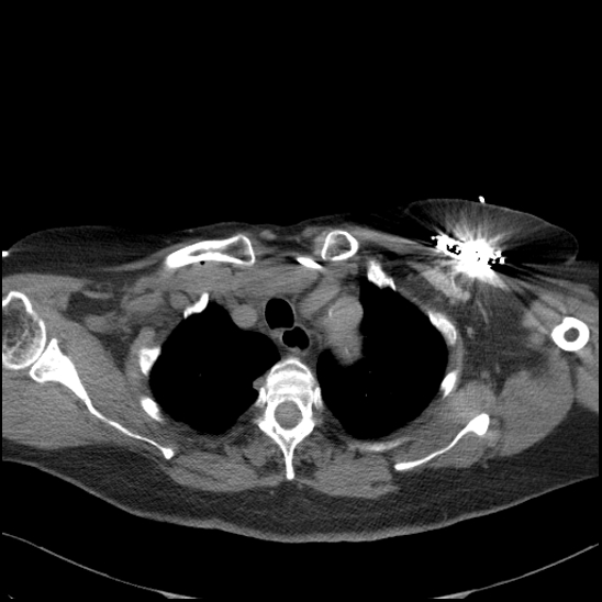 Aortic intramural hematoma with dissection and intramural blood pool (Radiopaedia 77373-89491 Axial non-contrast 21).jpg