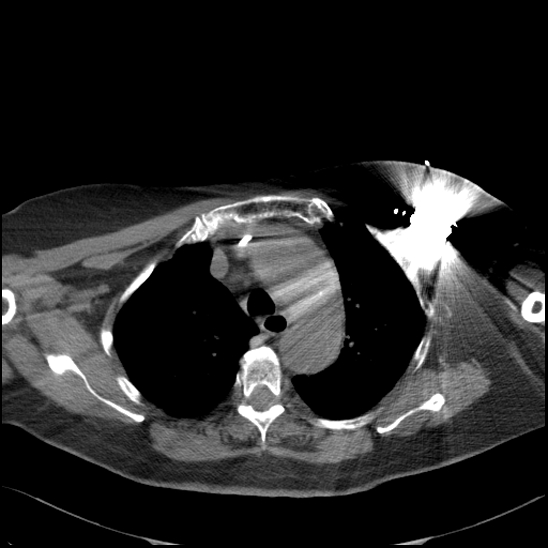 Aortic intramural hematoma with dissection and intramural blood pool (Radiopaedia 77373-89491 Axial non-contrast 28).jpg