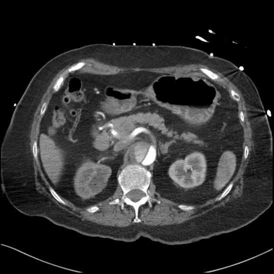 Aortic intramural hematoma with dissection and intramural blood pool (Radiopaedia 77373-89491 B 116).jpg