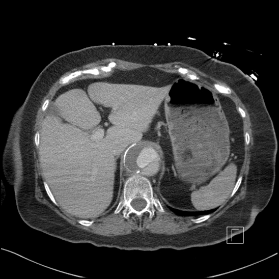 Aortic intramural hematoma with dissection and intramural blood pool (Radiopaedia 77373-89491 E 5).jpg