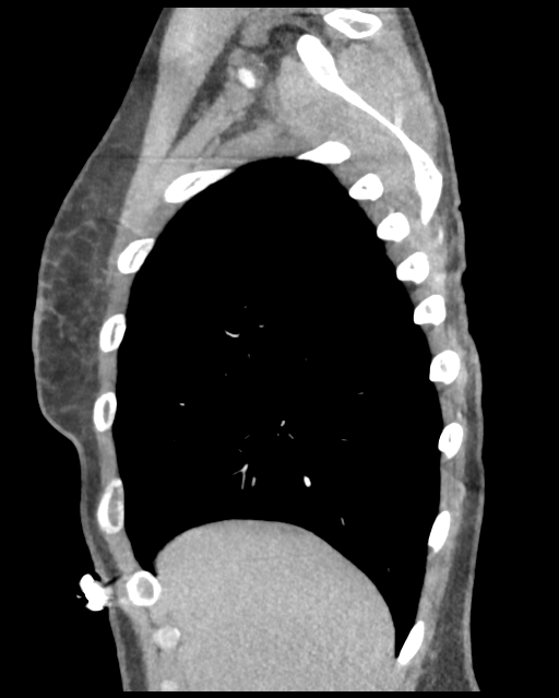 Aortic valve non-coronary cusp thrombus (Radiopaedia 55661-62189 D 45).png