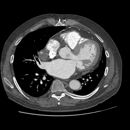 File:Aorto-coronary bypass graft aneurysms (Radiopaedia 40562-43157 A 72).png