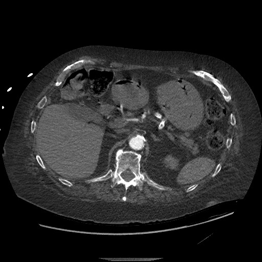 File:Aortoesophageal fistula with endovascular repair (Radiopaedia 73781-84592 Axial 170).jpg