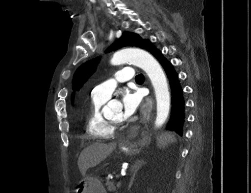 Aortoesophageal fistula with endovascular repair (Radiopaedia 73781-84592 Sagittal C+ CTPA 118).jpg