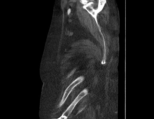 Aortoesophageal fistula with endovascular repair (Radiopaedia 73781-84592 Sagittal C+ CTPA 191).jpg