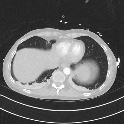 Apical bullous disease in a heavy smoker (Radiopaedia 33067-34092 Axial lung window 49).png