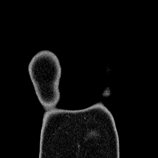 File:Apical lung mass mimic - neurogenic tumor (Radiopaedia 59918-67521 B 25).jpg
