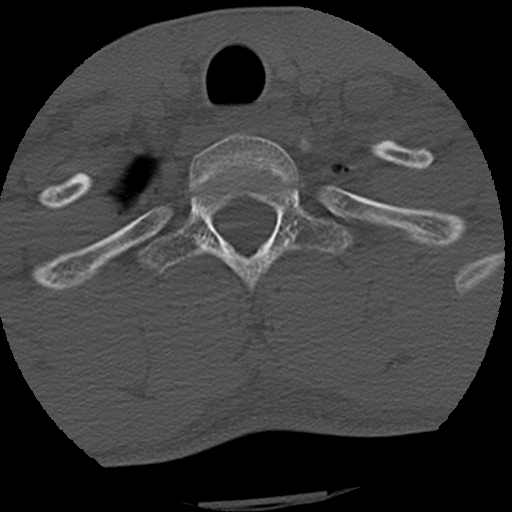Apical pneumothorax on cervical spine CT (Radiopaedia 45343-49368 Axial bone window 83).jpg