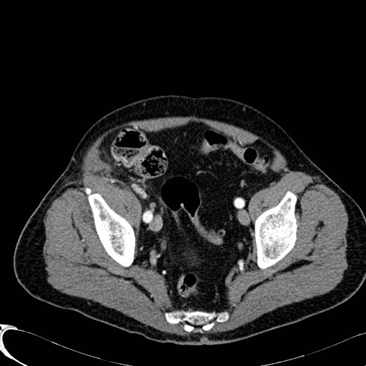 File:Appendiceal adenocarcinoma complicated by retroperitoneal abscess (Radiopaedia 58007-65039 B 121).jpg