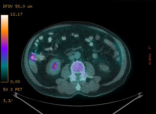 Appendiceal adenocarcinoma complicated by retroperitoneal abscess (Radiopaedia 58007-65041 Axial PET-CT 133).jpg