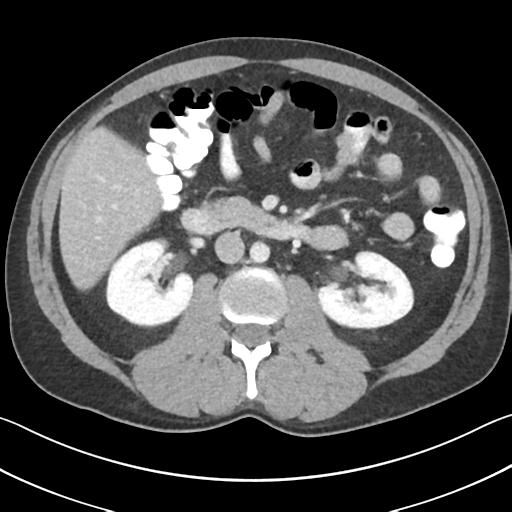 Appendicitis with cecal bar sign (Radiopaedia 31878-32830 B 35).jpg