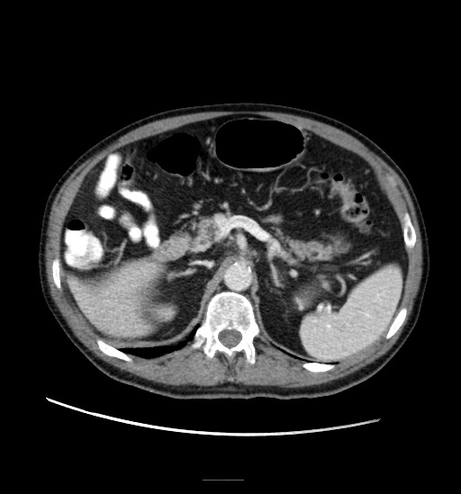 Appendicitis with localized perforation and abscess formation (Radiopaedia 49035-54130 A 31).jpg