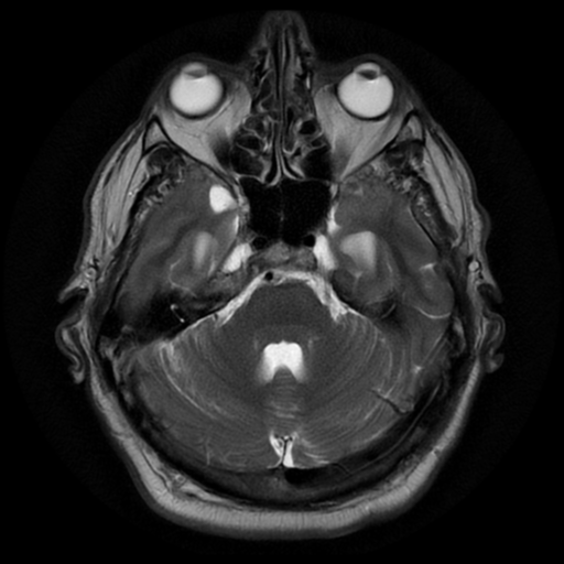 File:Aqueduct stenosis with corpus callosum hypoattenuation post shunting (Radiopaedia 37212-38969 Axial T2 5).png