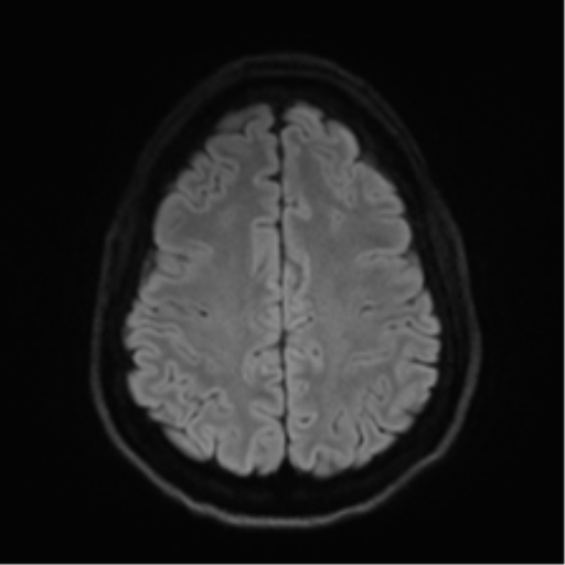Arachnoid cyst - cerebellopontine angle (Radiopaedia 59689-67083 Axial DWI 63).png