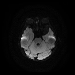 Arachnoid cyst - middle cranial fossa (Radiopaedia 86780-102938 Axial DWI 20).jpg