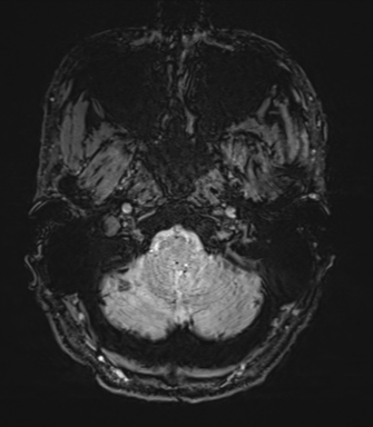 Arachnoid cyst with subdural hematoma (Radiopaedia 85892-101743 Axial SWI 6).png