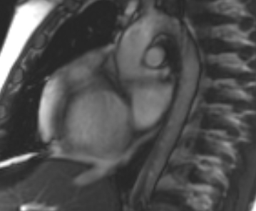 Arrhythmogenic right ventricular cardiomyopathy (Radiopaedia 69431-79307 Short axis cine 255).jpg