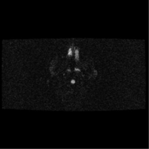 File:Arteriovenous malformation (cerebral) (Radiopaedia 40070-42580 Axial DWI 2).png