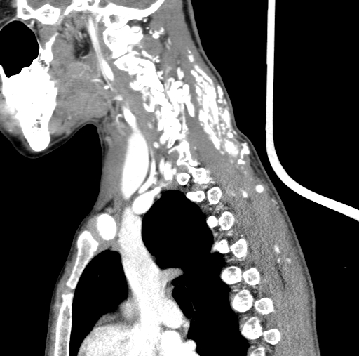 File:Arteriovenous malformation of the neck (Radiopaedia 53935-60062 C 46).jpg