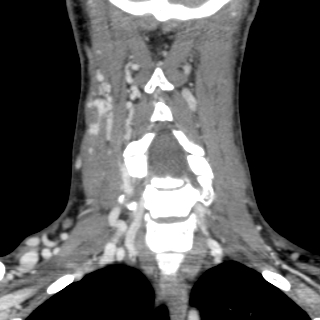 Arteriovenous malformation of the neck (Radiopaedia 53935-60062 D 21).jpg