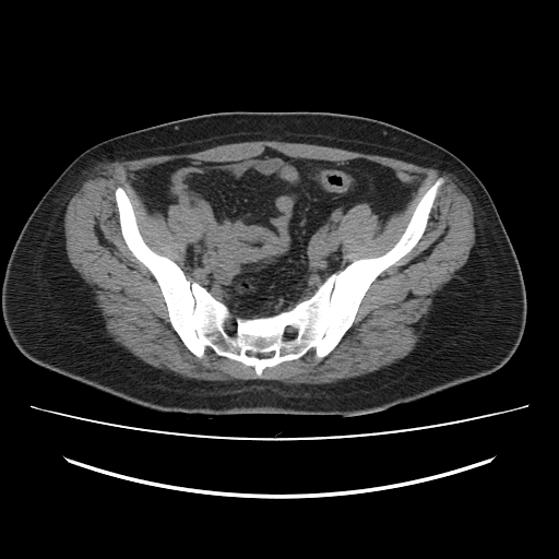 File:Ascending retrocecal appendicitis with liver abscesses (Radiopaedia 60066-67615 Axial non-contrast 69).jpg