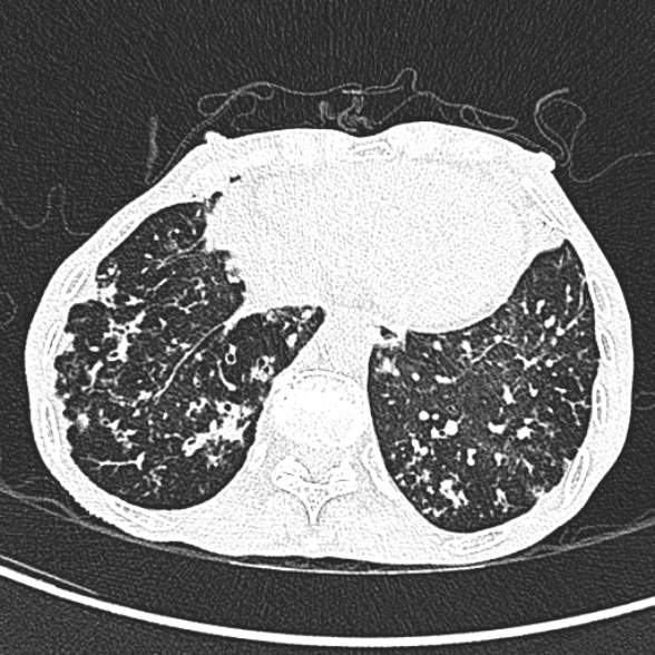 Aspergilloma- with Monod sign (Radiopaedia 44737-48532 Axial lung window 229).jpg