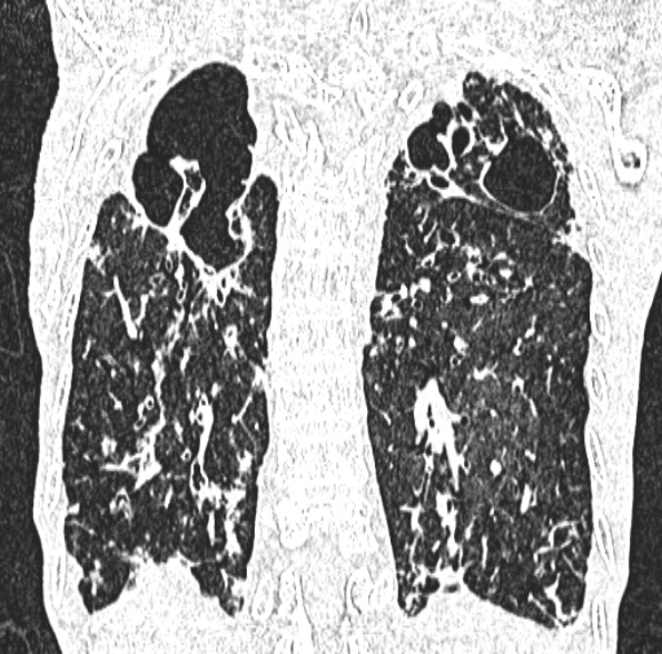 Aspergilloma- with Monod sign (Radiopaedia 44737-48532 Coronal lung window 342).jpg