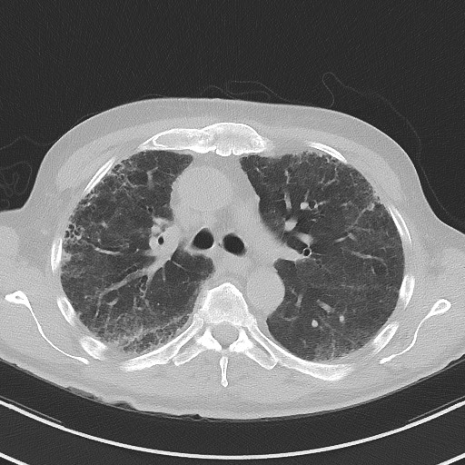 File:Aspergilloma on background pulmonary fibrosis (Radiopaedia 60942-68757 A 22).jpg