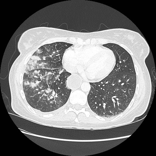 Aspiration pneumonia secondary to laparoscopic banding (Radiopaedia 18345-18183 lung window 77).jpg