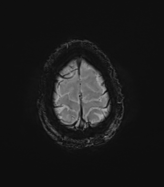 File:Astrocytoma, IDH-mutant - grade 3 (Radiopaedia 50046-55341 Axial 283).png