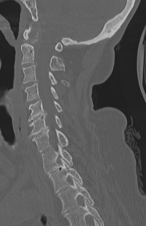 Atlanto-axial subluxation (Radiopaedia 36610-38176 Sagittal bone window 37).png