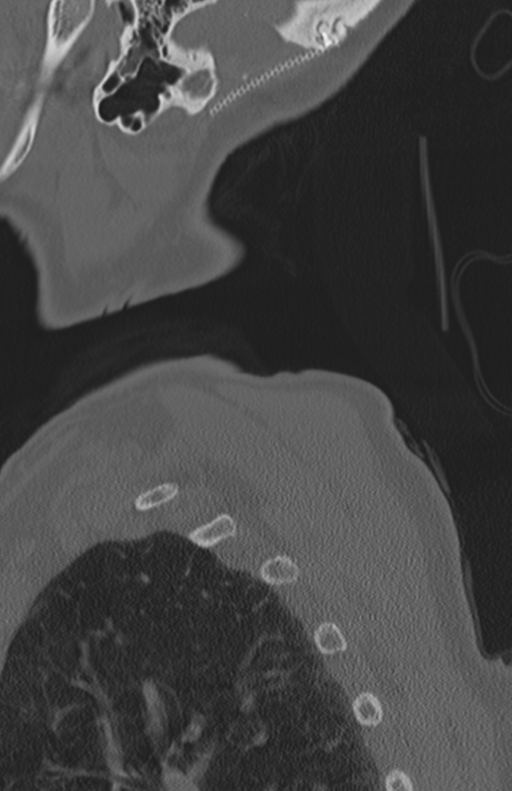 Atlanto-axial subluxation (Radiopaedia 36610-38176 Sagittal bone window 74).png