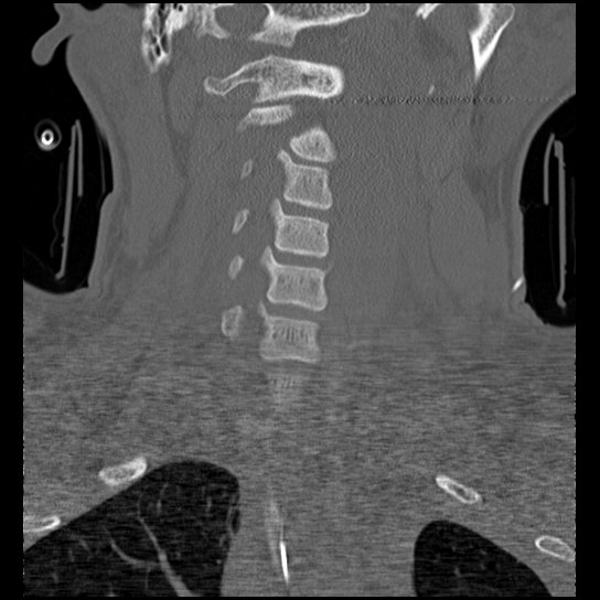 Atlanto-occipital dissociation injury (Radiopaedia 29274-29698 Coronal bone window 31).png