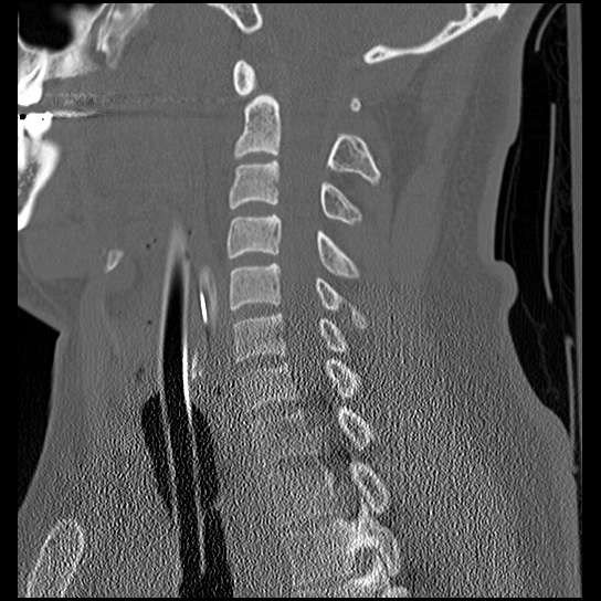 Atlanto-occipital dissociation injury (Radiopaedia 29274-29698 Sagittal bone window 30).png