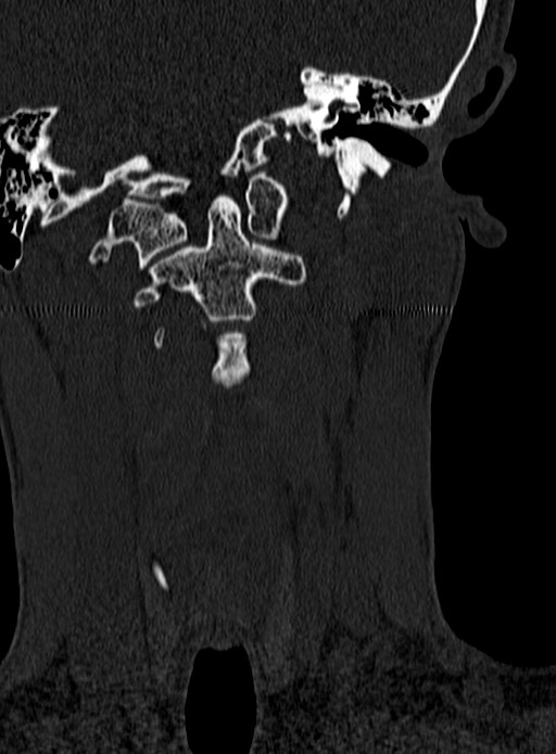 Atlantoaxial subluxation (Radiopaedia 44681-48450 Coronal bone window 18).jpg