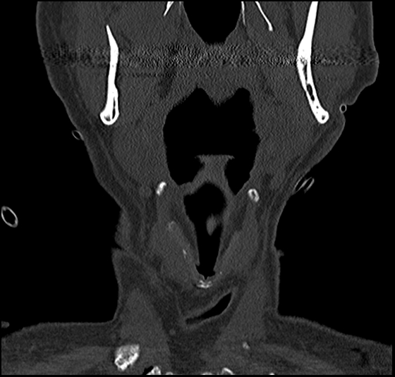 File:Atlas (type 3b subtype 1) and axis (Anderson and D'Alonzo type 3, Roy-Camille type 2) fractures (Radiopaedia 88043-104607 Coronal bone window 5).jpg