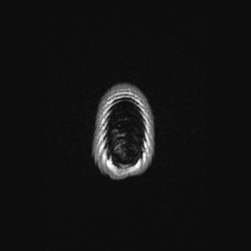 Atretic encephalocoele with inferior vermis hypoplasia (Radiopaedia 30443-31108 Axial 151).jpg