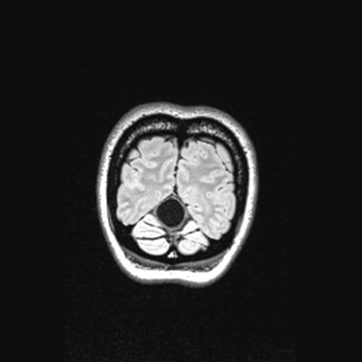 Atretic encephalocoele with inferior vermis hypoplasia (Radiopaedia 30443-31108 Coronal FLAIR 27).jpg