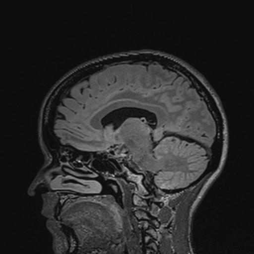 Atretic encephalocoele with inferior vermis hypoplasia (Radiopaedia 30443-31108 Sagittal FLAIR 74).jpg