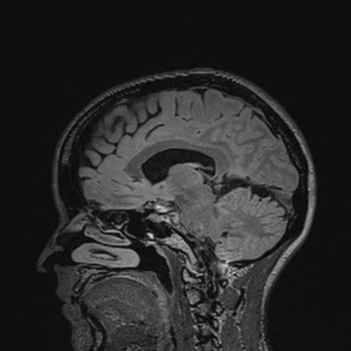 Atretic encephalocoele with inferior vermis hypoplasia (Radiopaedia 30443-31108 Sagittal FLAIR 76).jpg