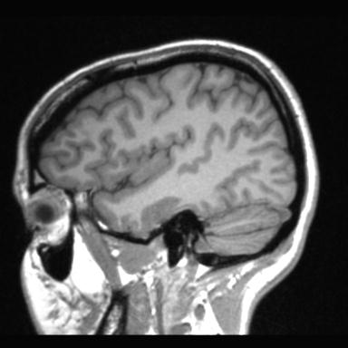 Atretic encephalocoele with inferior vermis hypoplasia (Radiopaedia 30443-31108 Sagittal T1 104).jpg