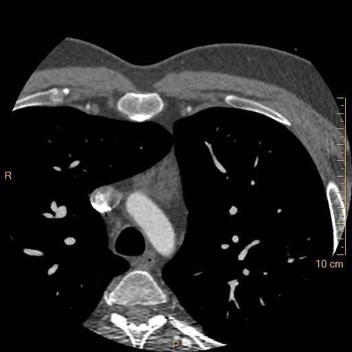 Atrial septal defect (upper sinus venosus type) with partial anomalous pulmonary venous return into superior vena cava (Radiopaedia 73228-83961 A 1).jpg