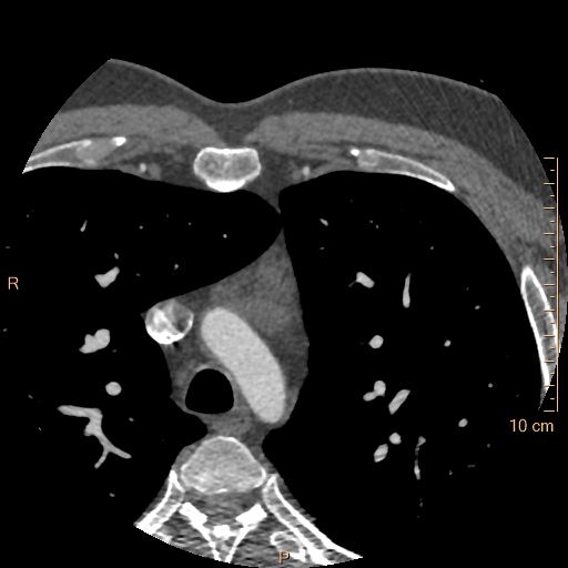 File:Atrial septal defect (upper sinus venosus type) with partial anomalous pulmonary venous return into superior vena cava (Radiopaedia 73228-83961 A 5).jpg
