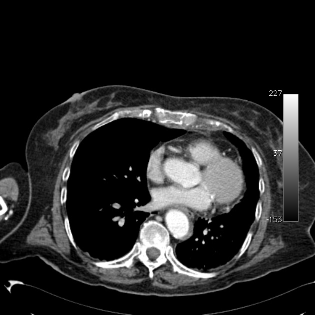 Atypical dissection of the thoracic aorta (Radiopaedia 10975-11393 A 46).jpg